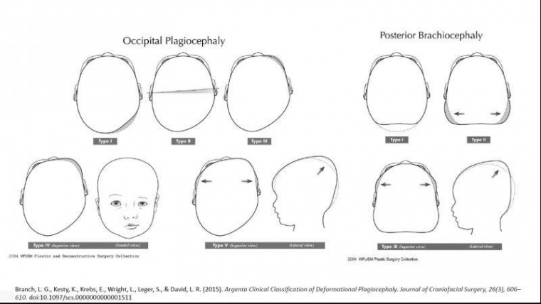 La tête plate du bébé : Plagiocéphalie / Brachycéphalie (déformation du crâne), Toulouse, Quentin Semanaz